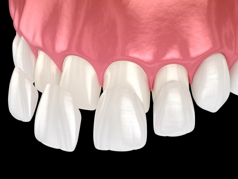 Dental Veneers