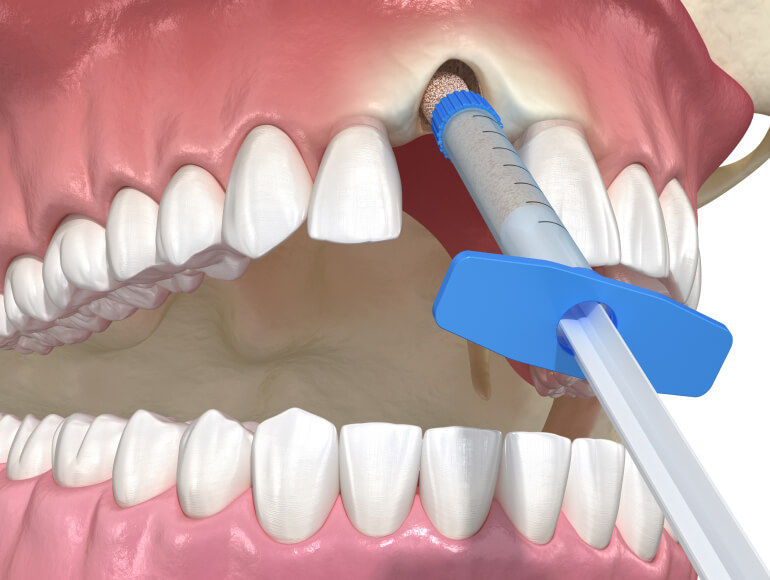 Bone Grafting