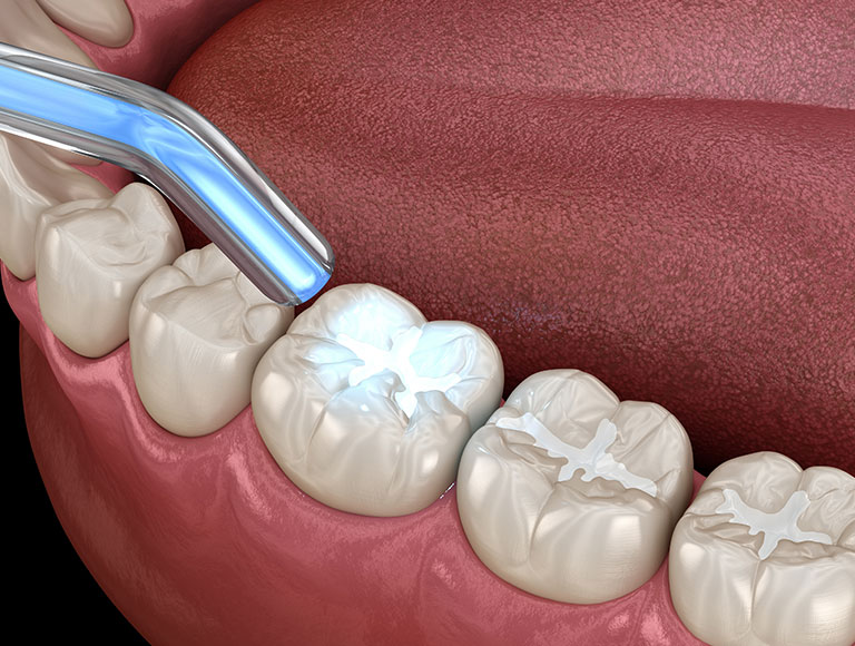 Fight Cavities Head-On
