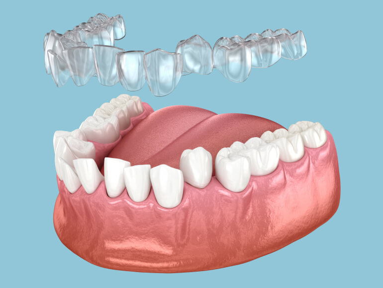 Achieve a Perfect Smile with Invisalign — Valley View Dental Manteca CA