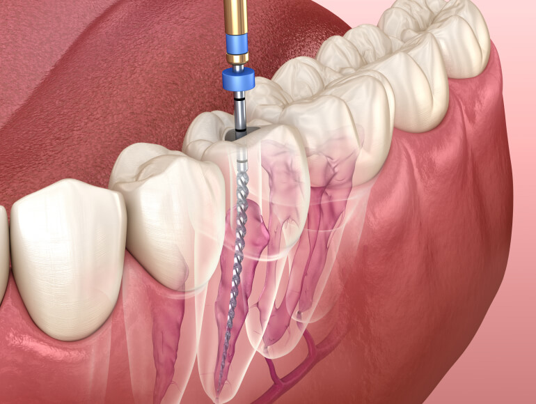 Signs You Might Need Root Canal Therapy