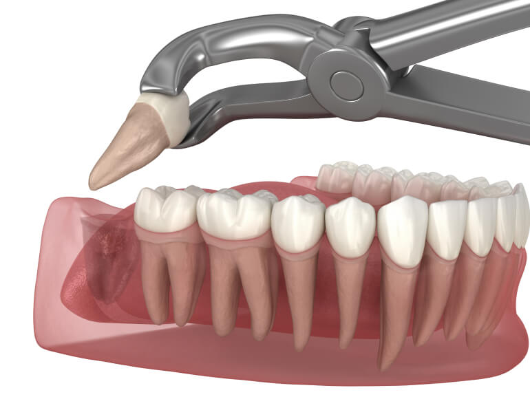 Say Goodbye to Tooth Pain